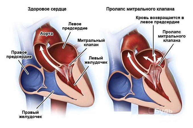 Пролапс митрального клапана – порок сердца