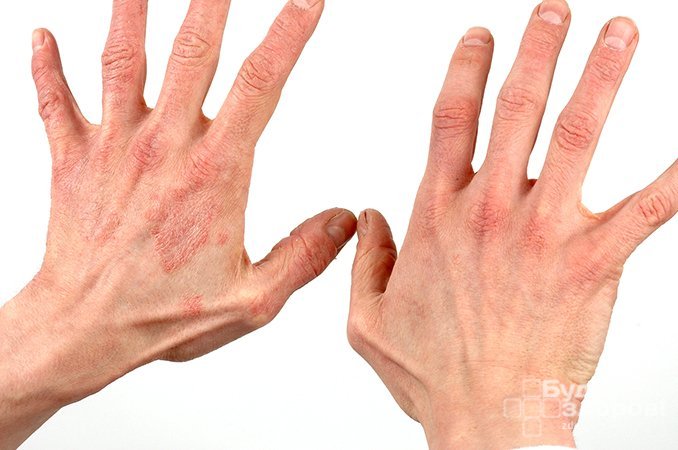 Дерматит — воспалительное заболевание кожи