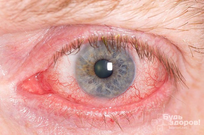Покраснение и отек слизистой оболочки - симптомы ожога глаза