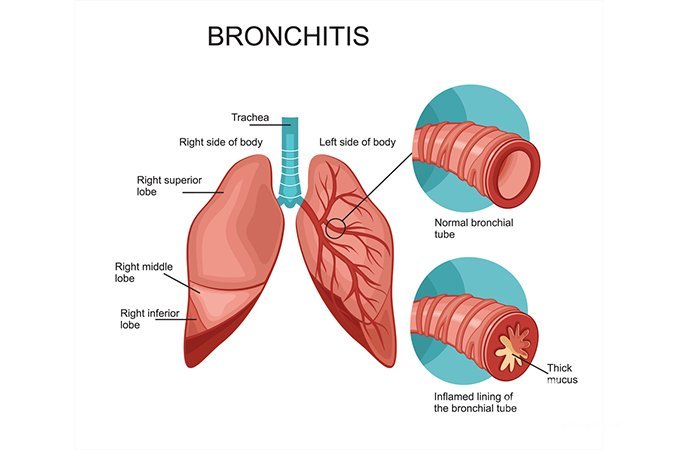 Сильный кашель - основной симптом острого бронхита
