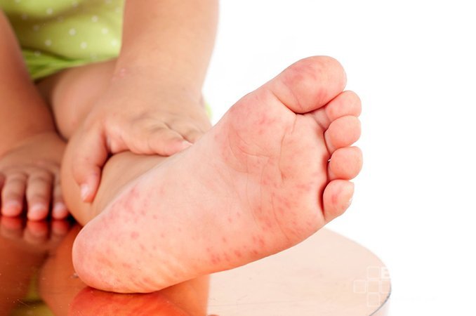 Мелкая сыпь на коже ног - один из симптомов псевдотуберкулеза