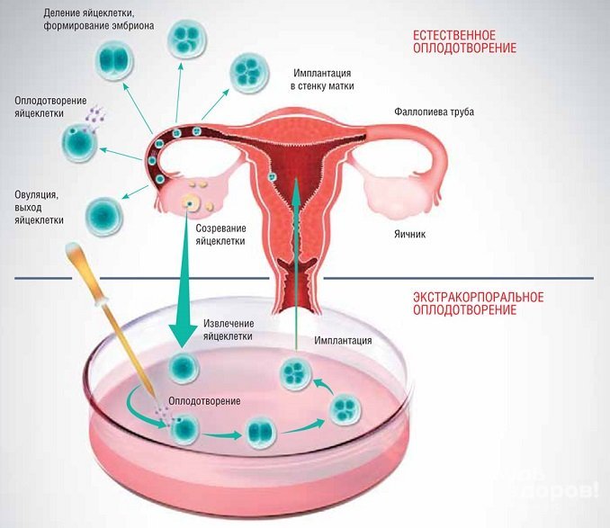 При экстратемпоральном оплодотворении уровень прогестерона поддерживают при помощи гормональной терапии