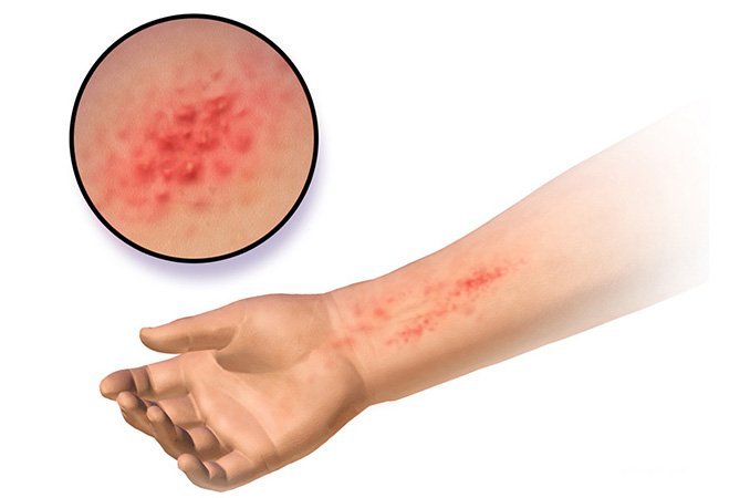 Характерная сыпь - основной симптом контактного дерматита