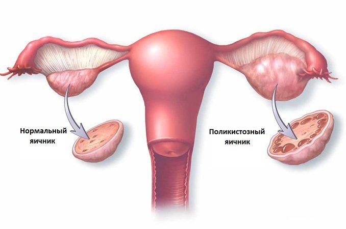 Поликистоз яичников - гормональное нарушение