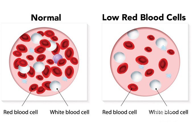 Понижение в крови гемоглобина или эритроцитов - анемия