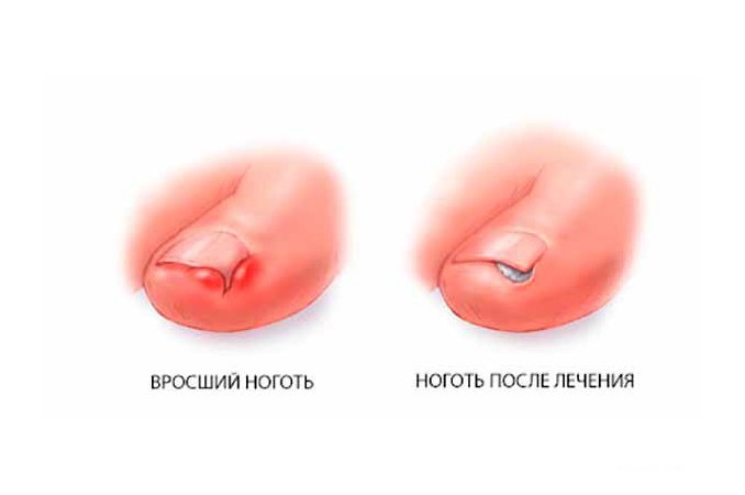 Вросший ноготь - врастание края ногтевой пластины в околоногтевой валик