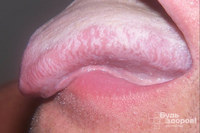 Лейкоплакия слизистой оболочки языка