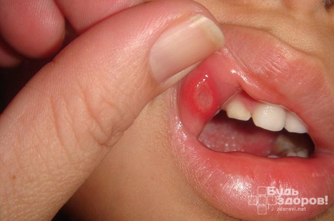 Язвочки на губах - первый симптом ящура