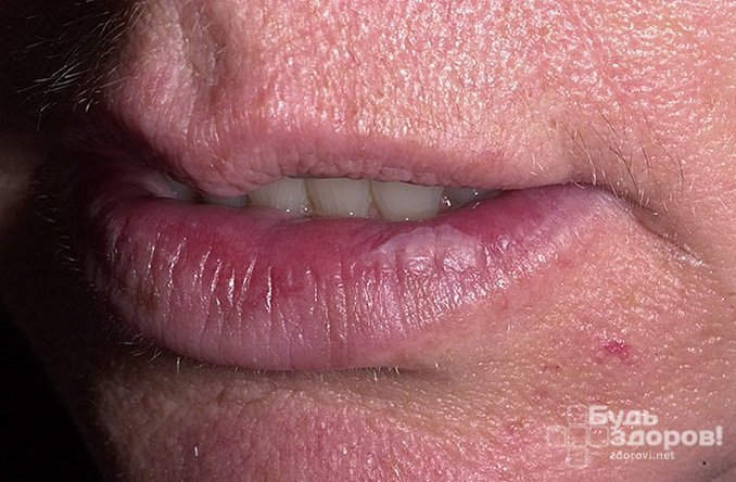 Лейкоплакия губ
