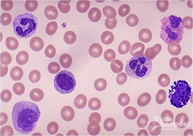 Кровь при хроническом миелоидном лейкозе