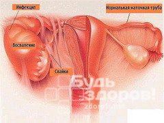 Оофорит (воспаление яичников) — одно из наиболее опасных гинекологических заболеваний