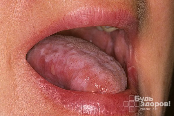 Появления красного плоского лишая в полости рта