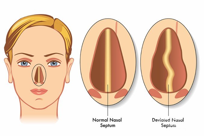 Искривление перегородки носа: симптомы, последствия