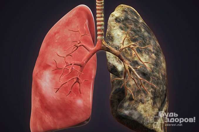 Беспричинный изнурительный кашель - один из симптомов рака легких