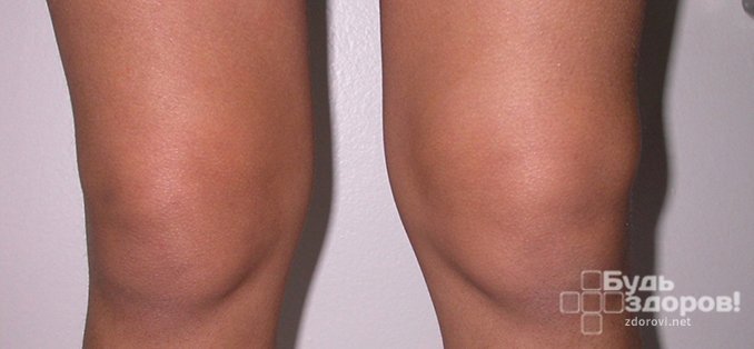 Остеоартроз – одна из причин выпота коленного сустава