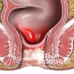 Парапроктит - воспаление прямой кишки