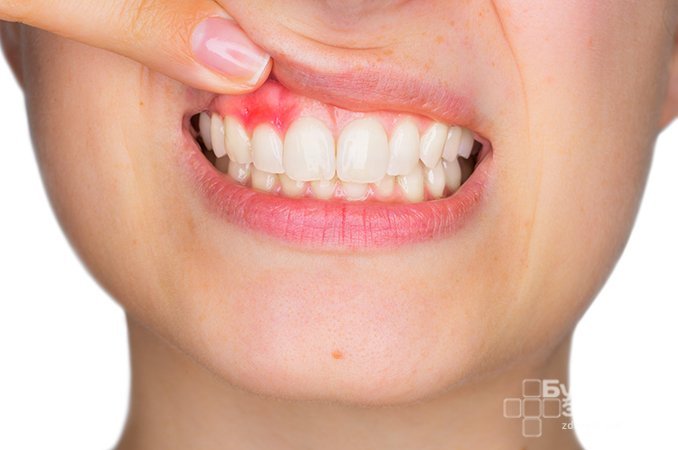 Гранулема зуба - ограниченное воспаление периодонта