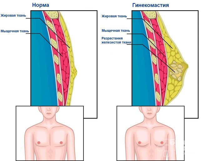 Повышенный эстрадиол у мужчин может привести к развитию гинекомастии