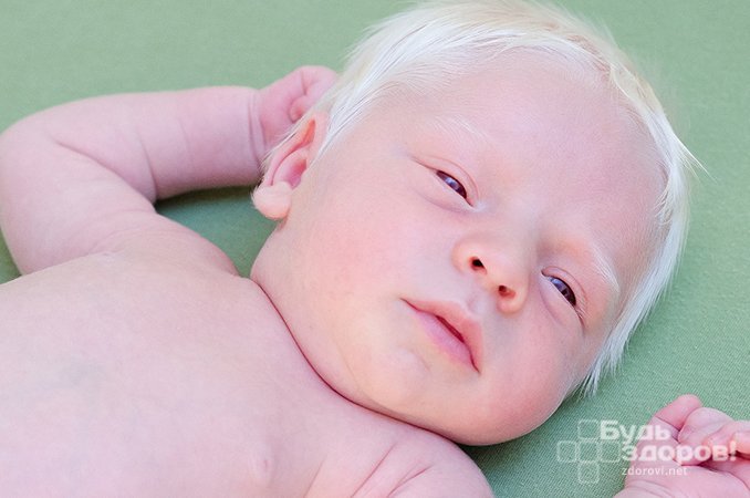 Признаки альбинизма у детей