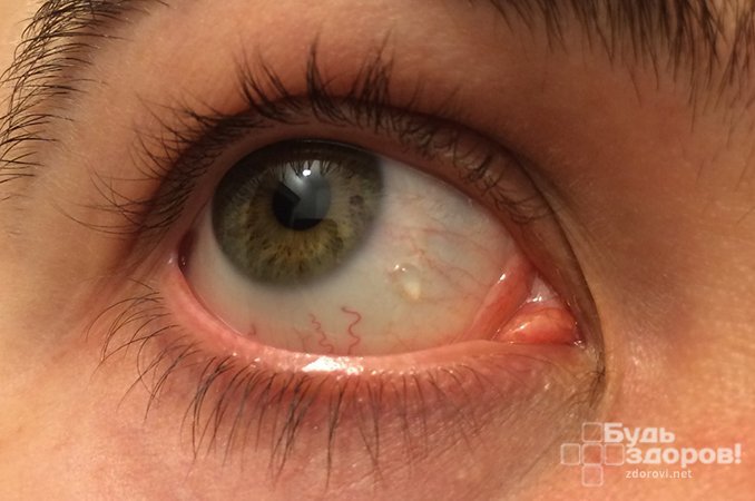 Воспалительные, дегенеративные и паразитарные процессы - основные причины образования кист глаза