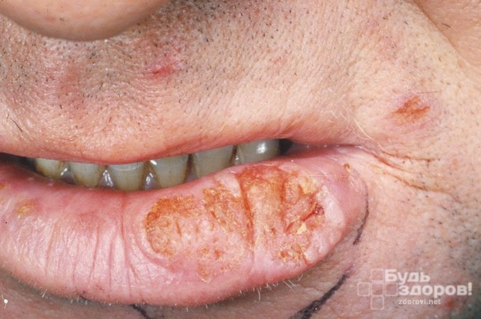 Рак губы развивается из клеток эпителия красной каймы губ