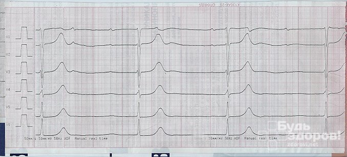Кардиограмма сердца при атриовентрикулярной блокаде