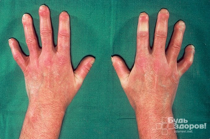 Симптомом системной склеродермии является бледная кожа рук из-за нарушения кровотока