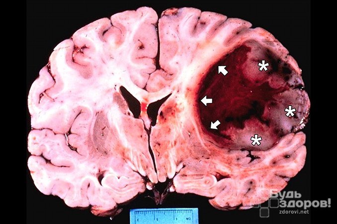 Глиобластома - опухоль головного мозга