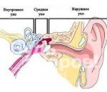 Болезнь Меньера - невоспалительное заболевание среднего уха