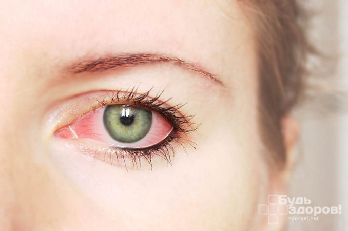 Кератит - воспаление роговицы глаза