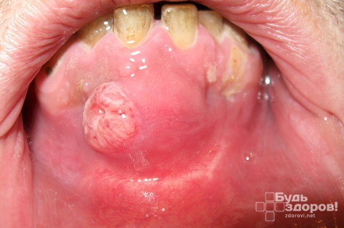 Рак полости рта покрывает внутреннюю поверхность рта, языка и губ