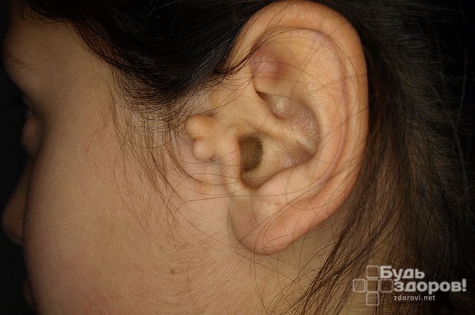 Зрелая тератома за ухом