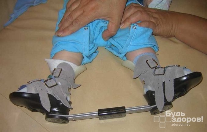 Обувь с брейсами – средство для профилактики рецидива косолапости у детей