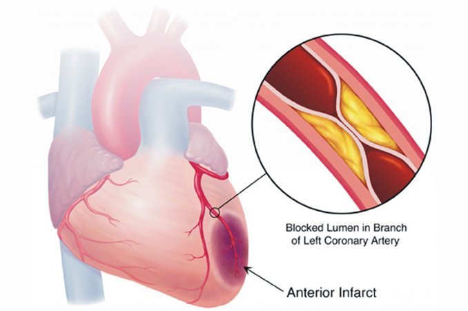 Ишемическая болезнь сердца - поражение миокарда