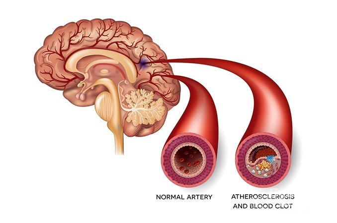 Гиперлипидемия - одна из причин развития атеросклероза мозга