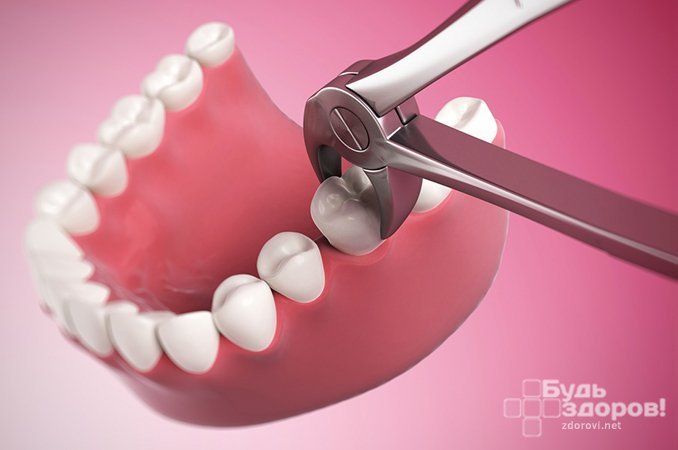Экзодонтия - процедура удаления зуба