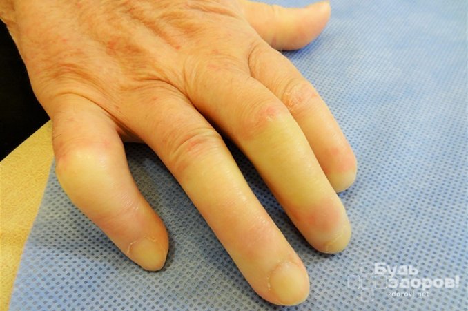 Кожа лица и рук у больных системной склеродермией ассоциируется с воском