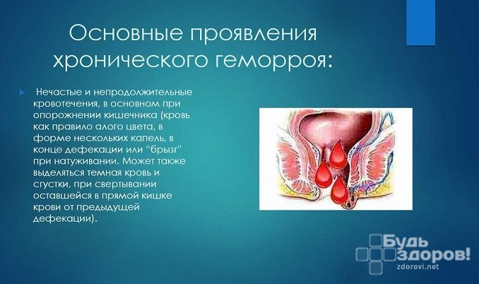 Лечение геморроя у женщин в возрасте thumbnail