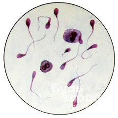 Олигоастенотератозооспермия - идиопатическая форма мужского бесплодия