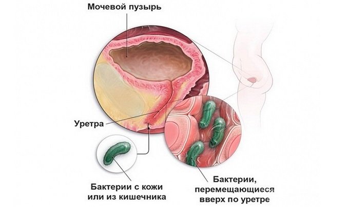 Инфекционный уретрит у женщин