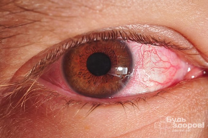 Ангиопатия сетчатки глаза — это изменение её капилляров и сосудов