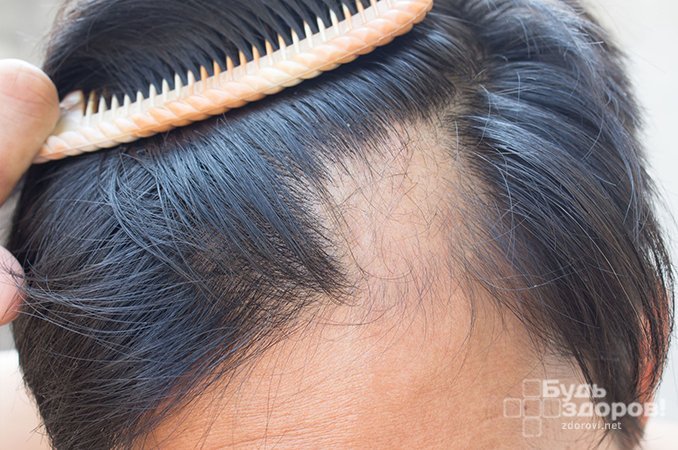Алопеция - выпадение волос