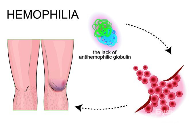 Гемофилия - врожденное заболевание
