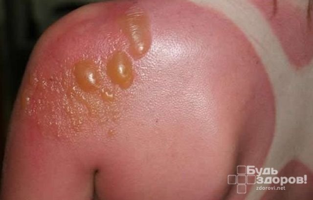от чего появляется аллергический дерматит по телу thumbnail