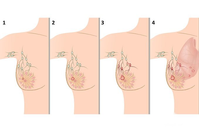 Виды и стадии рака молочной железы