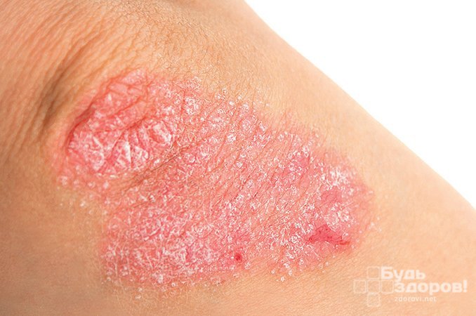 Псориаз - неинфекционное заболевание кожи