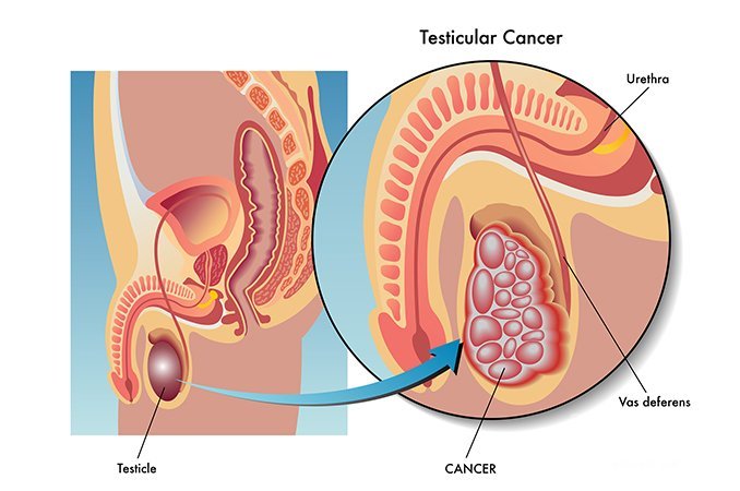 Рак яичка – это злокачественная опухоль, которая развивается в мошонке