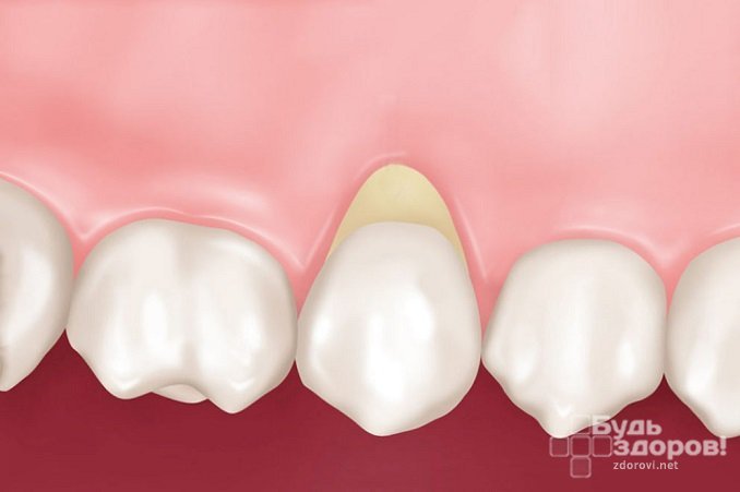 Единичный клиновидный дефект зубов