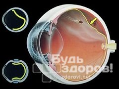 Процесс разрушения тканей - дистрофия сетчатки глаза