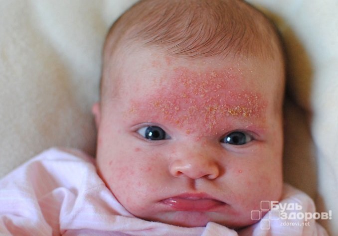 Появление гнейса на бровях – характерный симптом атопического дерматита у детей
